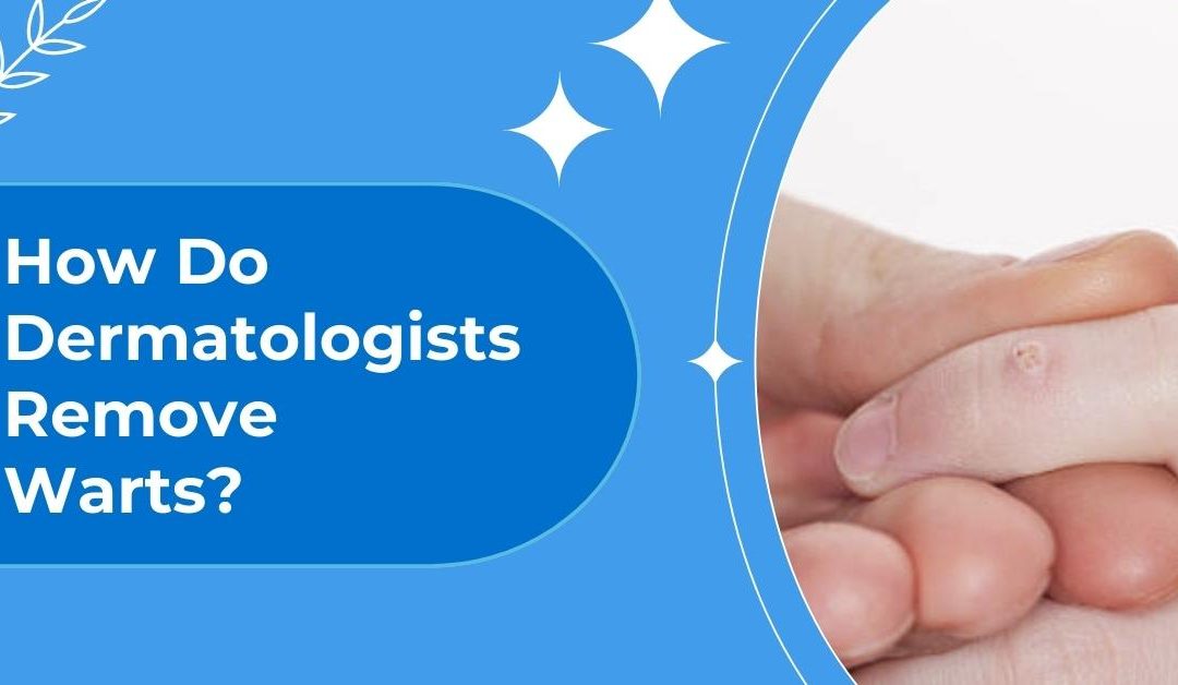 How Do Dermatologists Remove Warts?