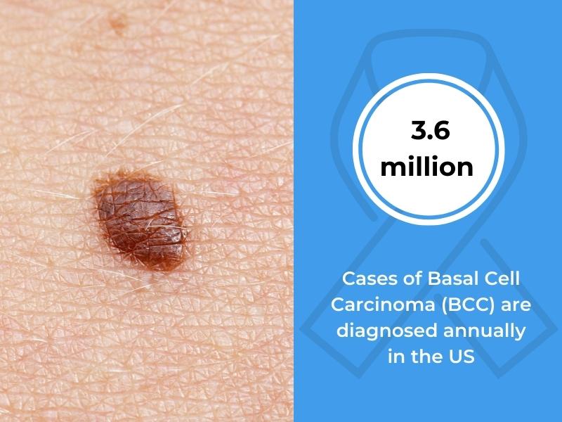 3.6 million cases of BCC are diagnosed annually in the US